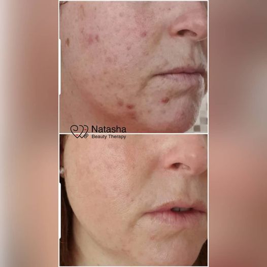 before and after skin transformations